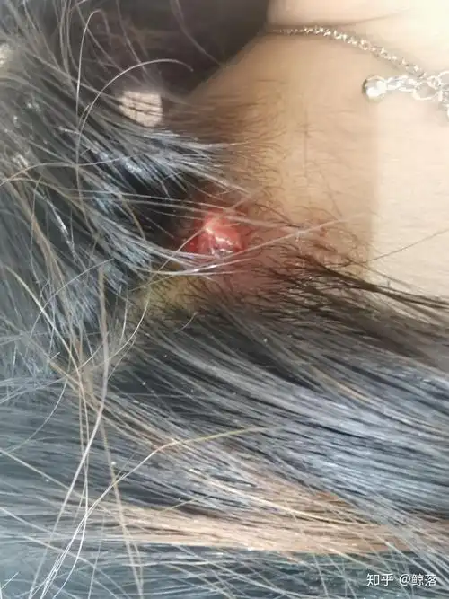 头皮上老是长痘痘,扣了是个血痂要不然就是按着疼的包,这是啥玩意啊?