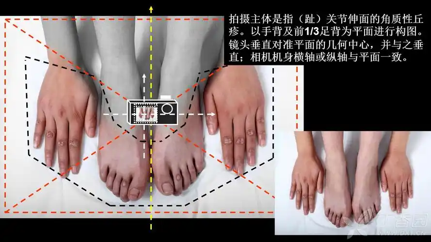 皮肤科摄影-患者体位及相机机位3_常规皮损拍摄(丁香园) [精华]