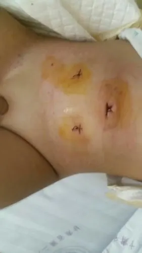 腹腔镜隐睾下降固定术