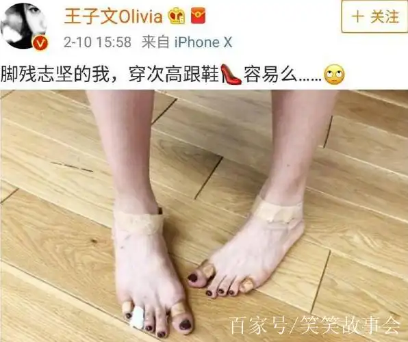 五位女星的脚,杨紫琼拇外翻,王子文惨不忍睹,她严重到要动手术