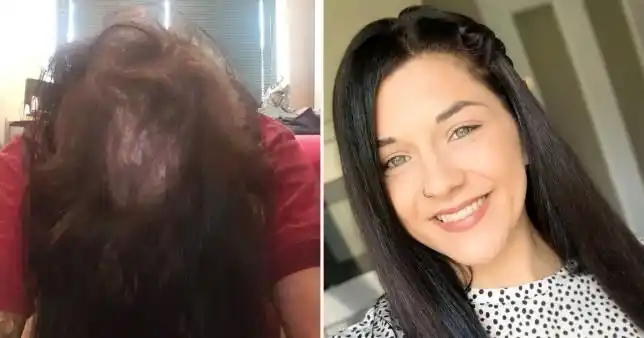 女子先得脱发症后患拔毛癖勇敢分享自己照片