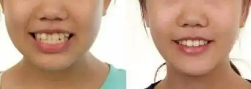 从未后悔给小孩牙齿矫正不信看戴牙套拔牙后的脸型变化