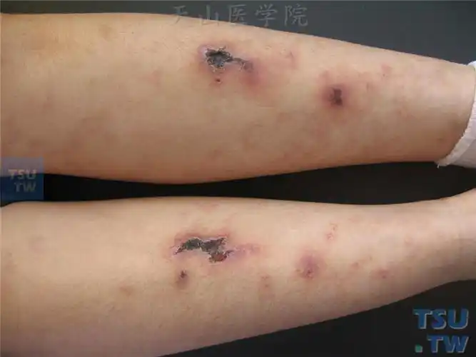 【图】变应性皮肤血管炎的症状表现 - 皮肤病诊断图谱 - 天山医学院