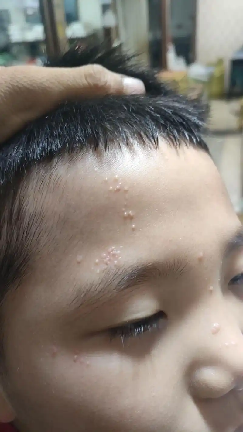 心累.#扁平疣 在医院里看到各种各样不同皮肤病患者,却每个人 - 抖音