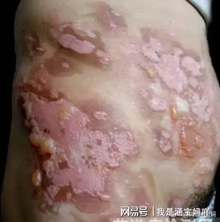 比新冠还可怕的病多地男性艾滋病疫情增长迅速