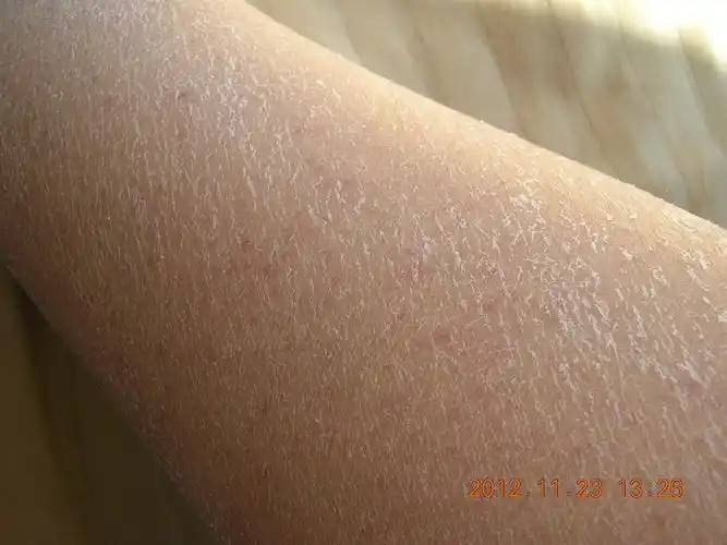 皮肤干成这样,怎么办