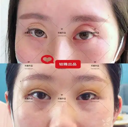 上睑凹陷行脂肪胶填充