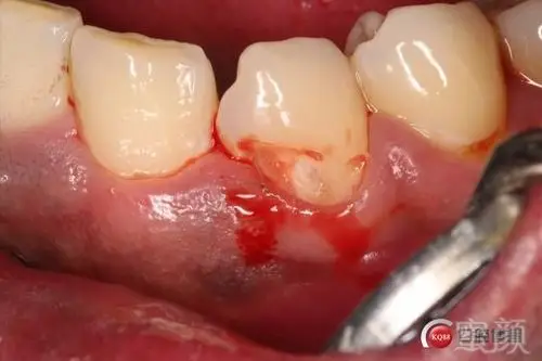 分享一组双尖牙根面龋补牙案例