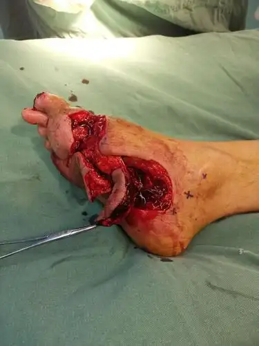 断足再植术后部分坏死,足底内皮瓣修复