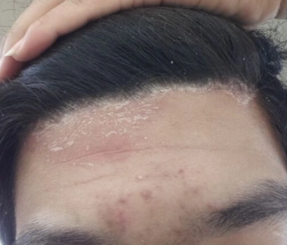 对于头部脂溢性皮炎的治疗,首先是一般的治疗,包括饮食,要避免辛辣