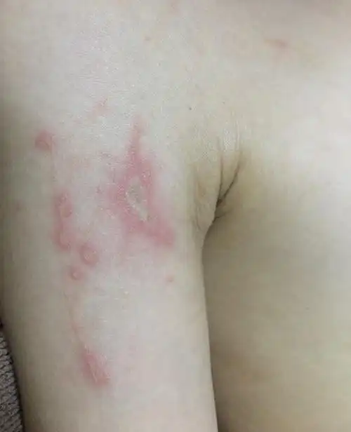 儿子11岁,最近几天发现胳膊皮肤出现发红溃疡一样的创面 , 去医院给_