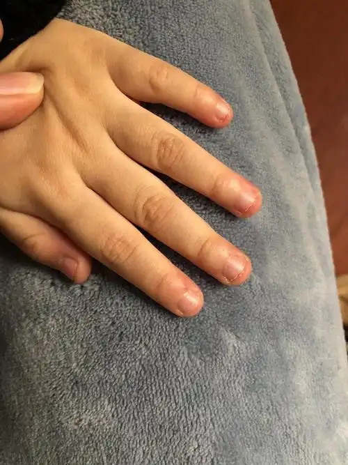 求助,孩子老是咬指甲怎么办?