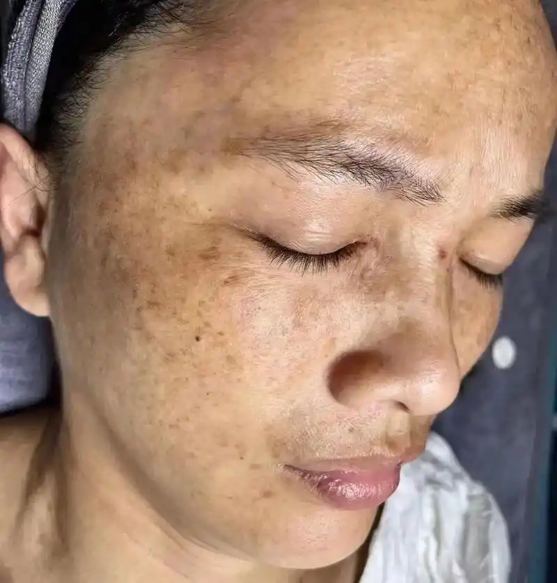 飞顿二二号祛斑,不是激动光,不破皮,不伤害皮肤角质层 - 抖音