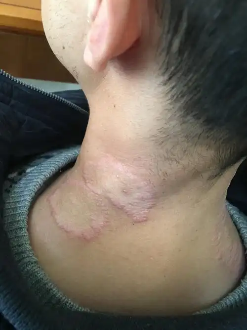 皮炎- 好大夫在线