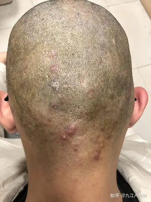 头皮毛囊炎的治疗之路