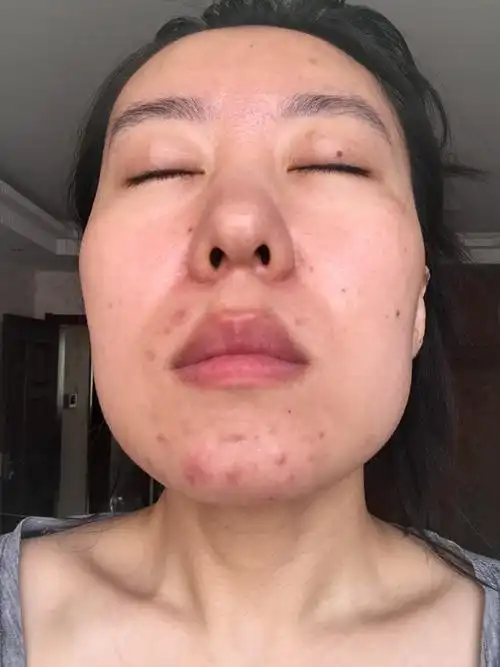 您好我的下巴一直反反复复长红肿的硬硬的有点疼的那种有大有小