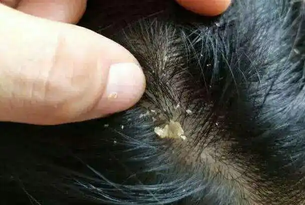 有头屑,头皮痒·······其实都是头皮没有护理好! - 美篇