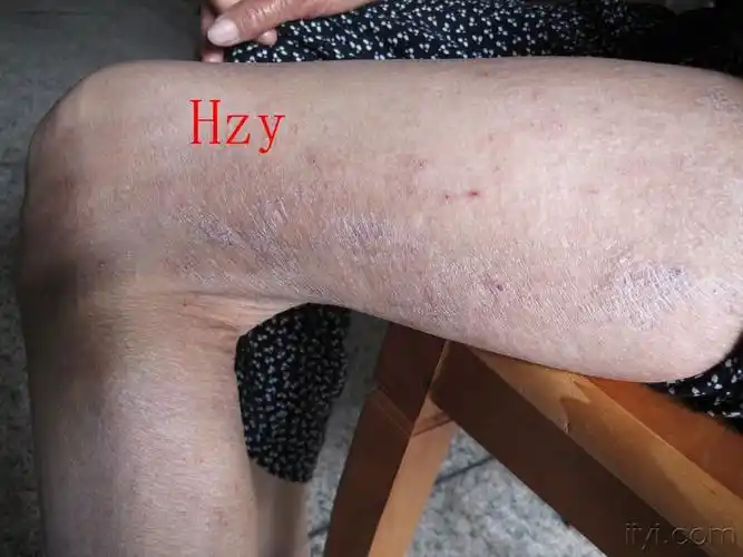 公布答案:老年性皮炎瘙痒症 - 皮肤及性传播疾病讨论版 - 爱爱医医学