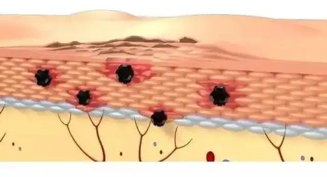 皮肤屏障受损后如何修复? - 好大夫在线