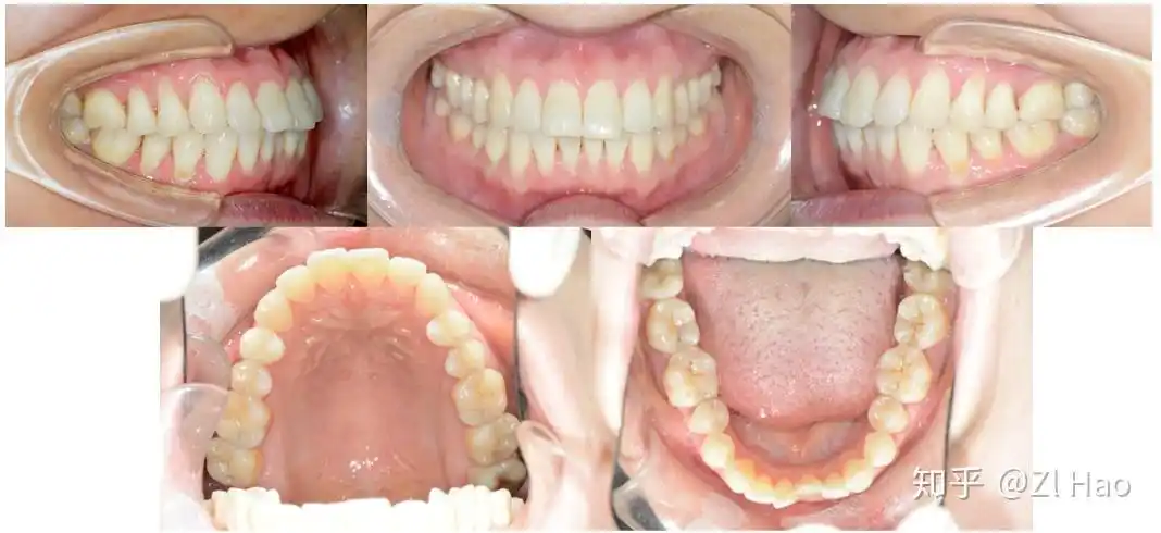 磨牙怎么解决? - 知乎
