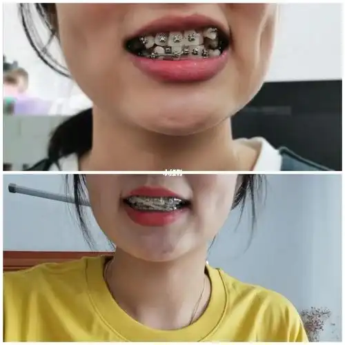 虎牙正畸_牙齿矫正_牙套_皮筋_美妆_医美整形