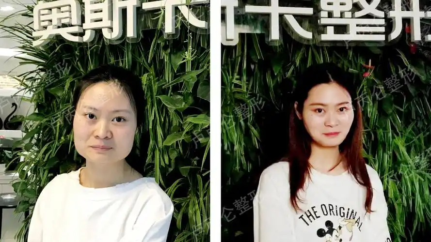 【案例展示】改脸型术后术前对比照!