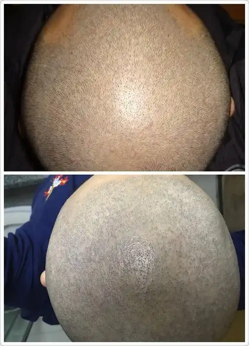 两个月的成果.以及和正常头皮毛囊对比
