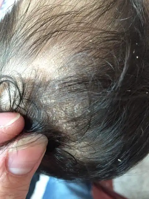 宝宝头上跟起头皮屑一样的东西,这是怎么回事啊?