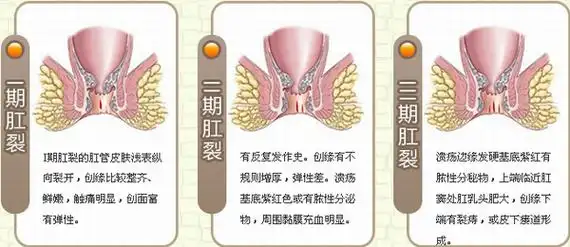 肛裂的症状详解_阜阳市医保农合医院【阜阳友好医院肛肠诊疗中心】阜