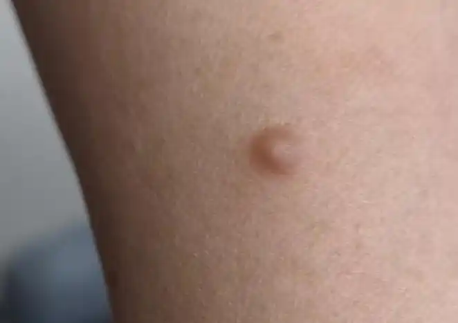 身上的小疙瘩——硬纤维瘤