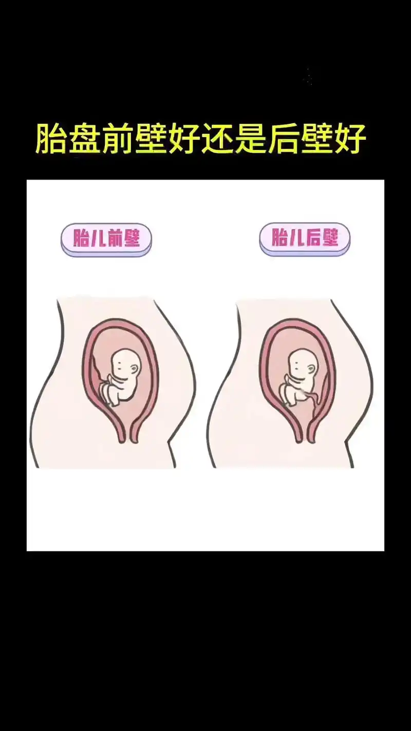 99996900胎盘前壁好还是后壁好?97胎盘