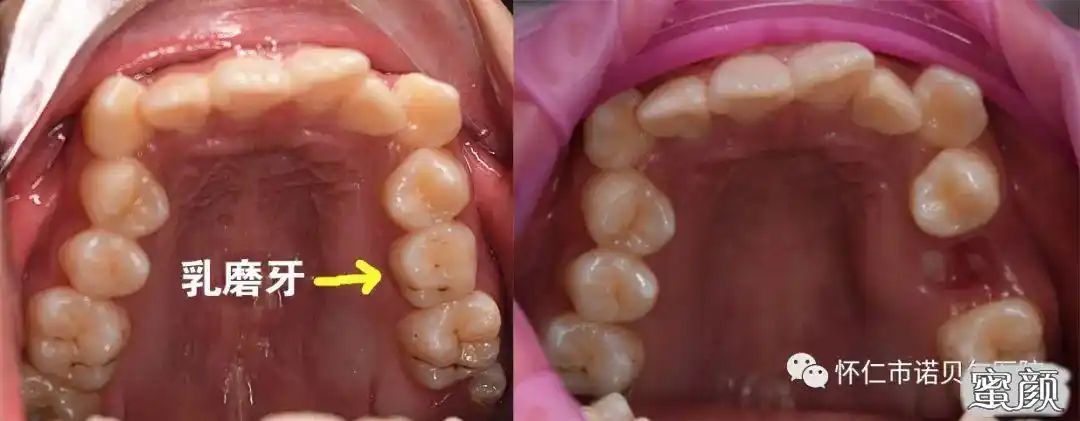 第二步:拔除左上颌未拔除的乳臼齿.第一步:牙周清洁.
