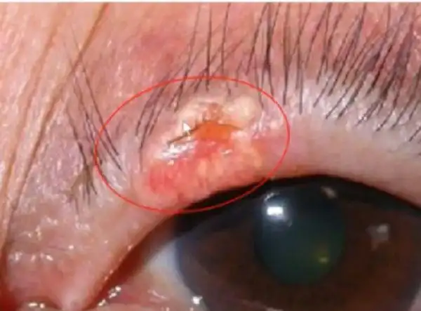 眼皮上长小疙瘩要注意什么?|睑板|肿块|麦粒肿|囊肿|溃疡_网易订阅