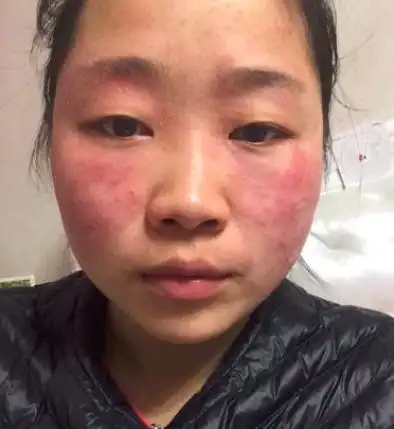 脸上湿疹擦什么,分析原因方能有效改善