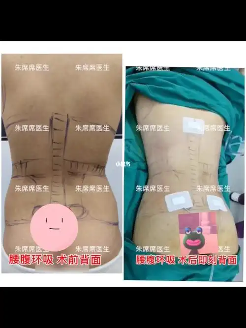 腰腹环吸抽脂第27天反馈来啦!