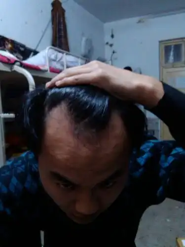 我适合什么发型?我的额头比较宽,头两边没头发,头发有点稀少.