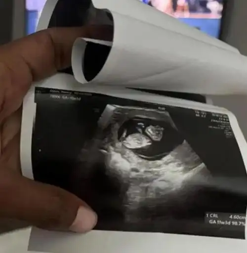 产检发现胎儿有致命缺陷,美国医生:本州禁止堕胎,必须继续怀着,直到他