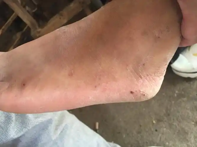 欢迎有脚气 脚臭 脚痒 水泡 脱皮 干裂 糜烂等症状的朋友进来看看.