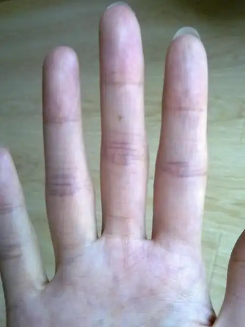 手上长痣揭秘手上中指痣的含义左手中指有痣的女人运势如何