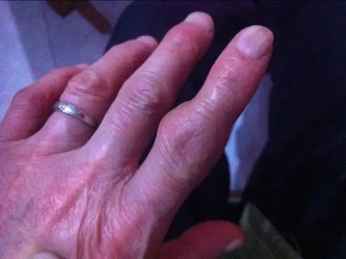 手指关节肿大疼痛肿大病情持续10多年了怎么是治疗是什么