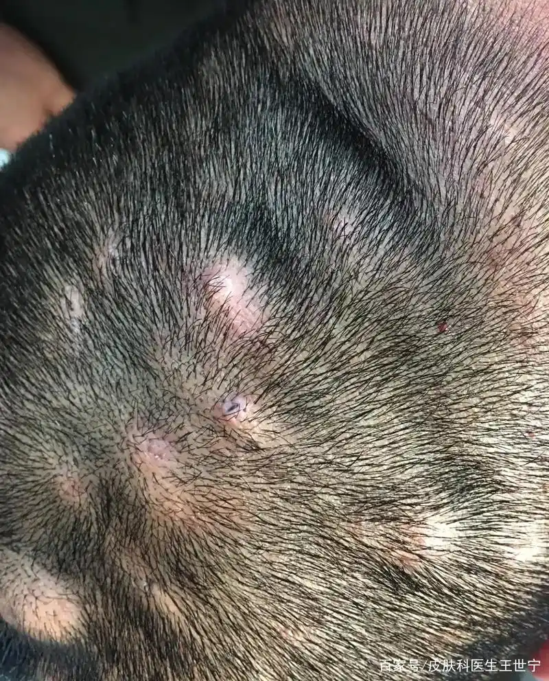 穿掘性毛囊炎!
