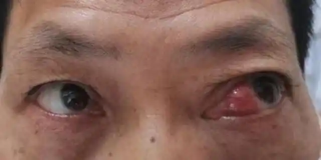 42岁男子眼角红肉竟是肿瘤,隐藏眼内14年夺眶而出