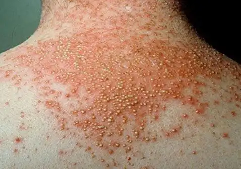 牛皮肤癣的症状图片