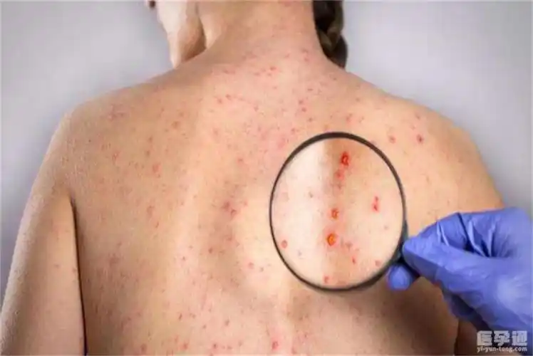 男性感染梅毒后的症状与图片参考这些症状的出现不可忽视