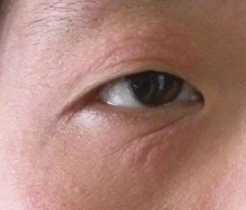 1条回答 2013-01-21 00:075201212智勇|六级 神经性皮炎,抹点膏药如