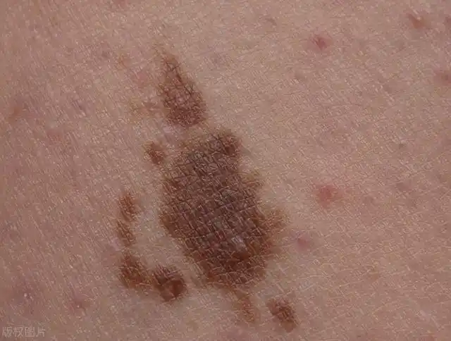 小腿上出现这种斑,预示糖尿病并发症已经出现,千万要提高警惕!