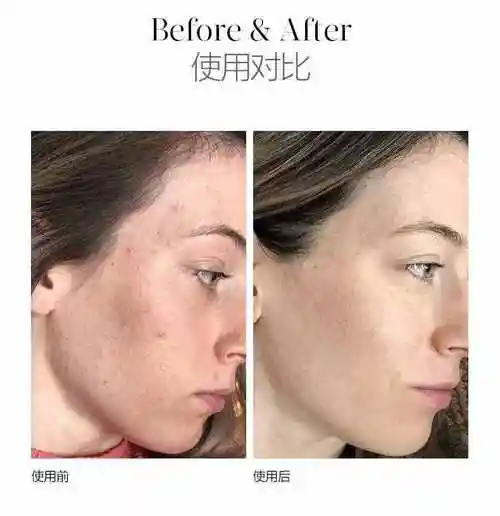 果酸换肤的功效果酸的作用有哪些