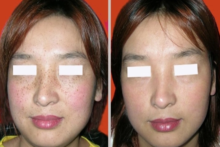 激光祛斑前后对比图
