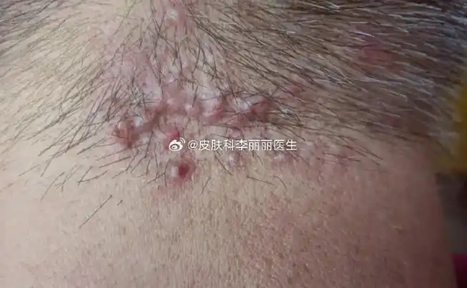后背总是出现"毛囊炎"怎么办?