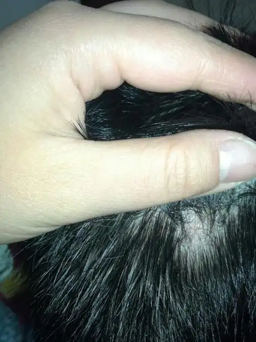 儿子头皮有一块儿老长痂,都八岁多了,怎么办?